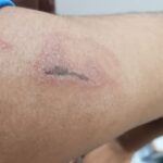 Nairobi Fly Symptoms and Treatment