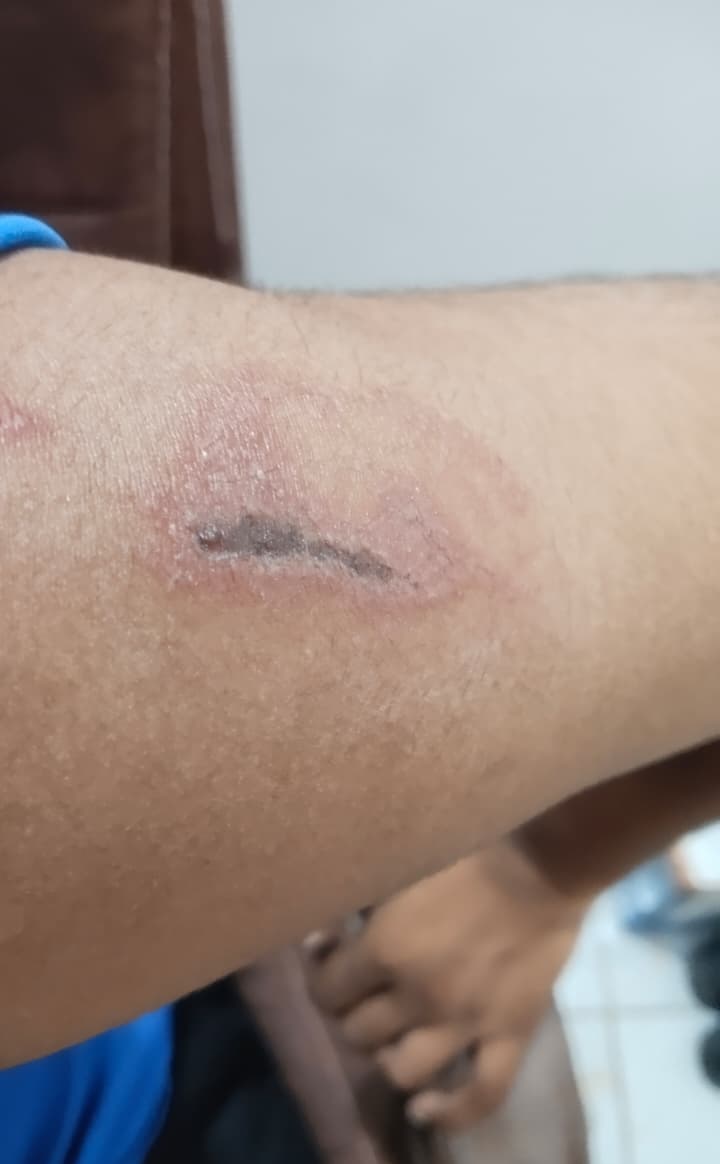 Nairobi Fly Symptoms and Treatment